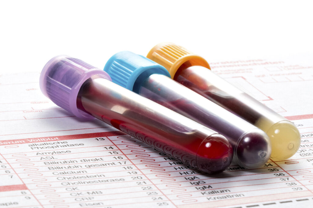 Blood Vials on top of Blood Chemistry Report